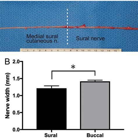 Demonstration of sural nerve graft to the buccal branch with end-to-end ...