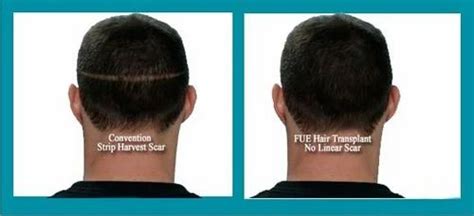 Fut Hair Transplant at best price in Bengaluru | ID: 14329716348