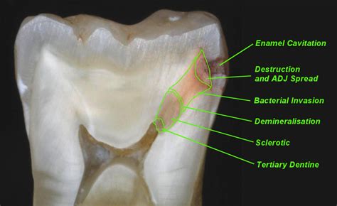 Diagnosis: Dental Caries. Dentine Caries