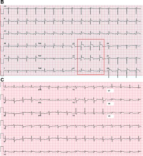 ECGs in Critical Care Cardiology: Do Not Miss That Myocardial ...