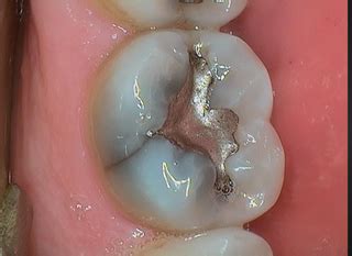 How To Classify the 5 Types of Cracked Teeth - Spear Education