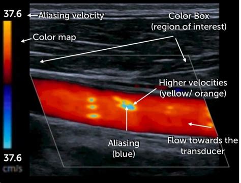 3. Instrumentation and physical principles of carotid (Duplex) ultrasound | 123 Sonography