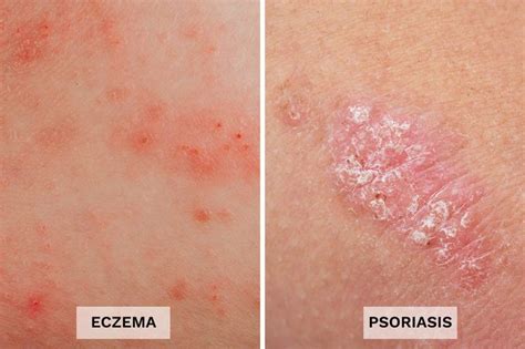 Eczema vs. Psoriasis: 13 Differences You Should Know | The Healthy