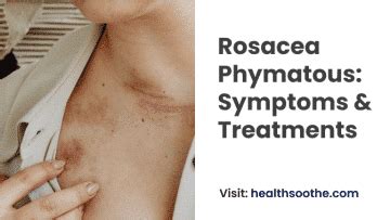 Rosacea Phymatous - Symptoms & Treatments Healthsoothe