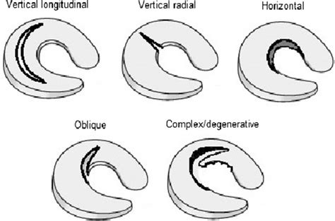 Meniscal Tear Types