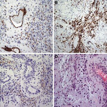 Histology of gliosarcoma. a 200×. Immunohistochemical staining for ...