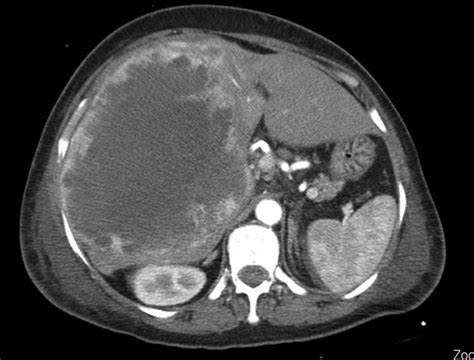 A Huge Mass in the Right Lobe of the Liver | Download Scientific Diagram