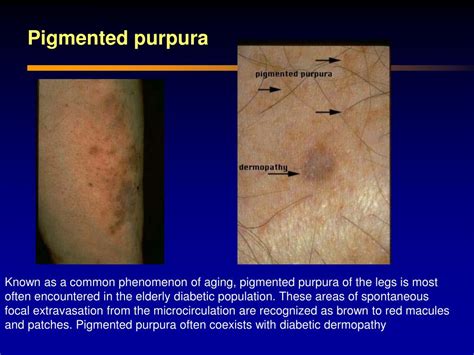 PPT - Diabetic Dermopathy PowerPoint Presentation - ID:460887