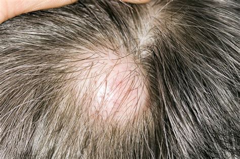 Sebaceous cyst on the scalp - Stock Image - C002/9582 - Science Photo Library