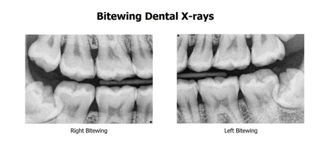 Bitewing radiograph is an intraoral x-ray showing the premolars and ...