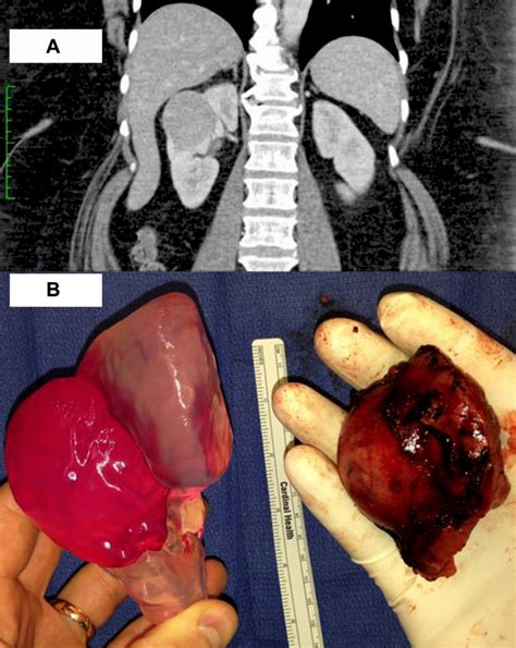 3D Printed Kidney Models Aid Surgery - 3D Printing Industry