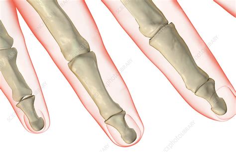 The bones of the fingers - Stock Image - F001/5701 - Science Photo Library