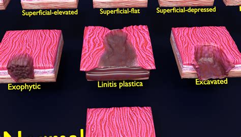 ArtStation - Gastric stomach cancer stages labelled | Resources