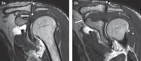 Spectrum of lesions of the acromioclavicular joint: imaging features | SMJ