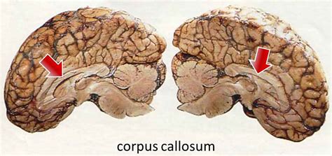 Split brain syndrome definition, causes, symptoms & experiments