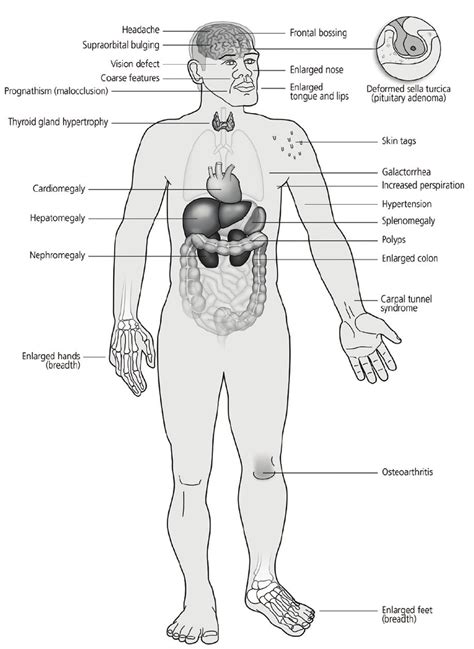 Acromegaly Diagram