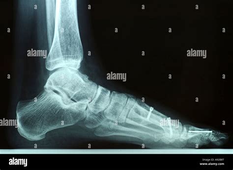 X-ray photo of a left foot after bunion surgery with screws and other hardware Stock Photo - Alamy