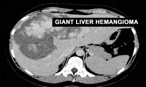 Cavernous Hemangioma Liver