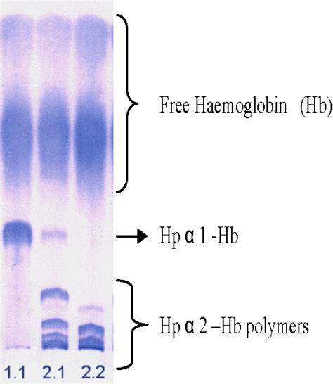 The Role of Haptoglobin and Its Genetic Polymorphism in Cancer: A ...