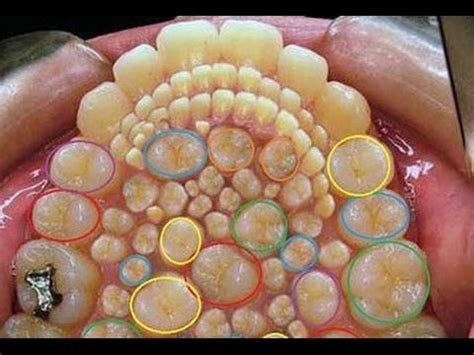 Hyperdontia Image a Hoax; Doctors remove 232 TEETH from boy's ... | Teeth braces, Orthodontic ...