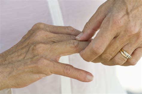 How to Get Rid of Arthritis in the Fingers