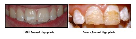 Fixing Enamel Hypoplasia - Auburn Dental