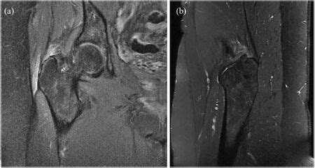 Gluteal Tendinopathy - WikiMSK