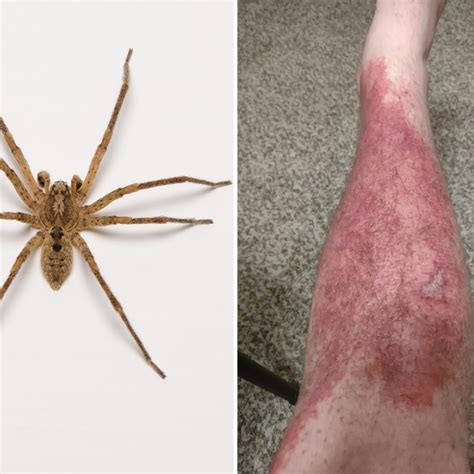 Photos Of A Brown Recluse Spider Bite The Health Guide