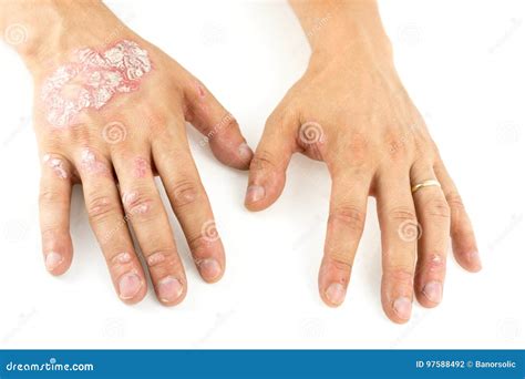 Psoriasis Vulgaris on the Mans Hands with Plaque, Rash and Patches, Isolated on White Background ...