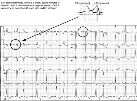 Chamber Abnormalities and Intraventricular Conduction Defects | ECG in 10 Days, 2e ...