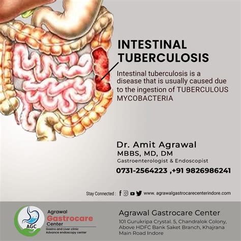 Intestinal tuberculosis, Symptoms, Treatment - Agrawal Gastrocare Center Indore