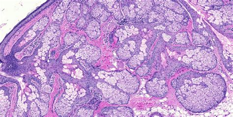 Teratoma Histology