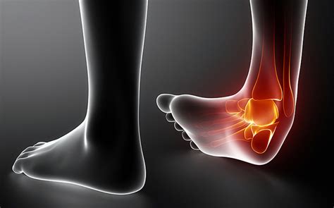 Acute Ankle Sprain