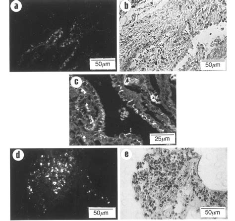 Distribution of B. cepacia in terminal bronchioles and peribronchiolar ...