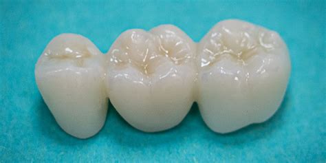 Dental Bridge in Glen Cove, Long Island | Zirconia Bridges