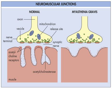 Myasthenia gravis — Medlibes: Online Medical Library