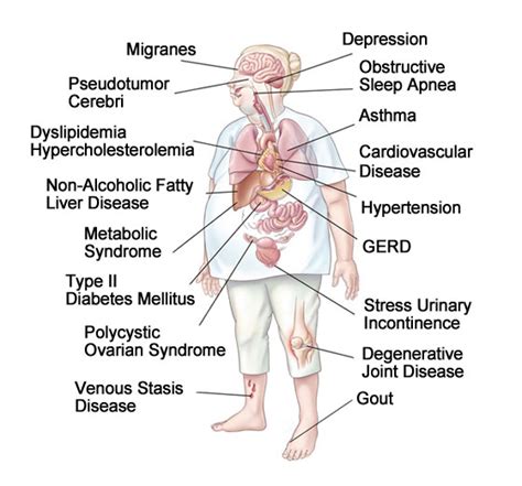 Obesity Related Illnesses (Comorbidities) - Bariatrix Florida