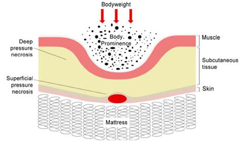 Top 172 + Pressure ulcer animation - Lifewithvernonhoward.com