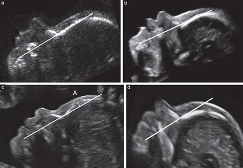 Down Syndrome Symptoms In Ultrasound