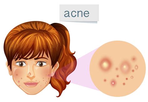 A Young Lady Acne on Face 302587 Vector Art at Vecteezy