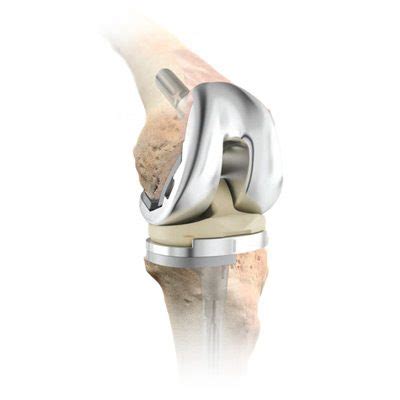 DePuy Attune Knee Replacements – Tibial Loosening