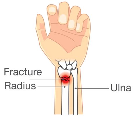 Distal radius fracture home exercise program