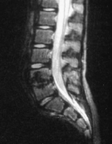 T2-weighted MRI showing deposition of haemosiderin manifesting as a low... | Download Scientific ...