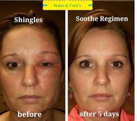 Today I learned that a Shingles rash can increase your risk for a bacterial infection on the ...