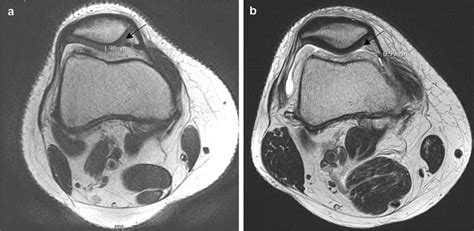 MRI analysis with measurement of the diameter of the medial patellar ...