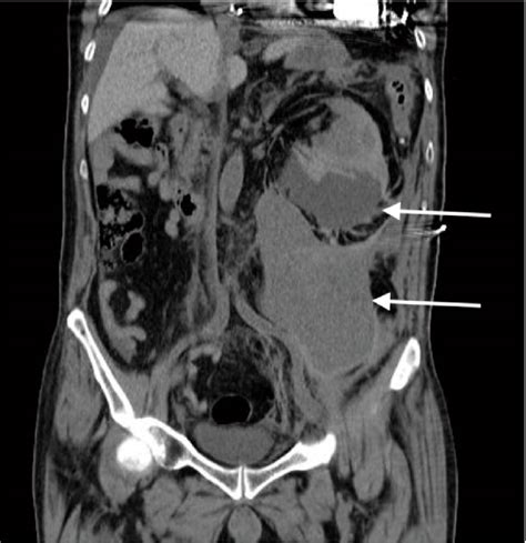 A massive left retroperitoneal hematoma is seen, composed of two ...