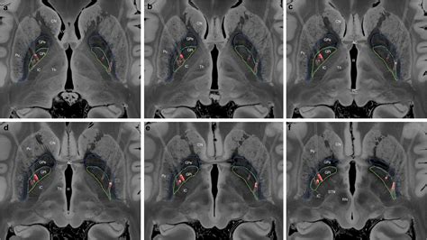 Frontiers | Globus Pallidus Internus Deep Brain Stimulation for Dystonic Opisthotonus in Adult ...