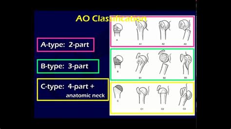 Proximal humerus fracture ao 463327-Proximal humerus fracture ao ...