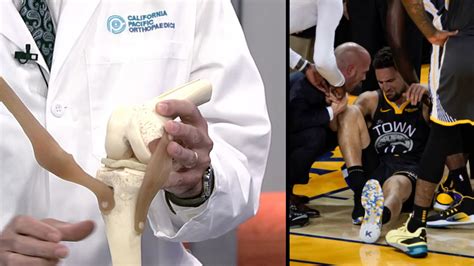 What is a torn ACL? Former Warriors Orthopedic Surgeon John Belzer demonstrates what happened to ...