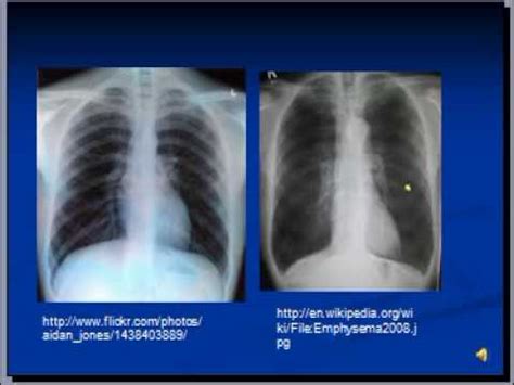 Chest x-ray interpretation --COPD and Emphysema - YouTube